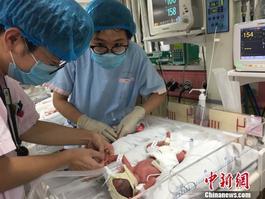 Identical natural quadruplets born in Shanghai: 1 in 13 million