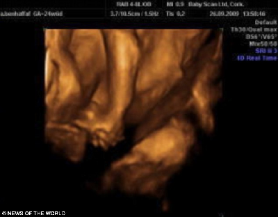 愛(ài)爾蘭連體雙胞胎成功分離 手牽手亮相溫馨感人