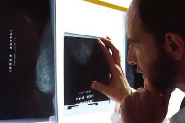 A doctor looks at an X-Ray showing breast cancer cells in this undated file photo. Tamoxifen, the pill that prevents breast cancer in high-risk women, does not appear in the long run to save many lives, U.S. researchers reported on Monday. (Files/Reuters)